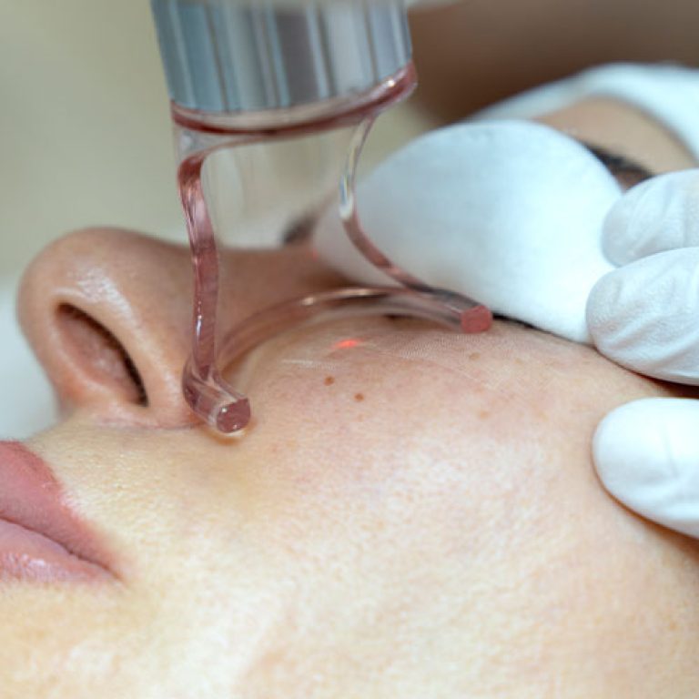 rimozione-lentiggini-02